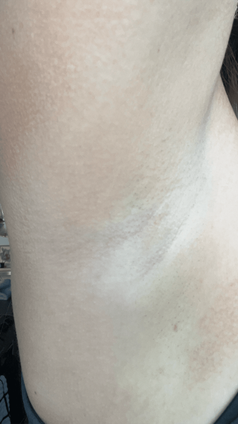 Wohlner after using the Braun Skin i·expert Smart IPL